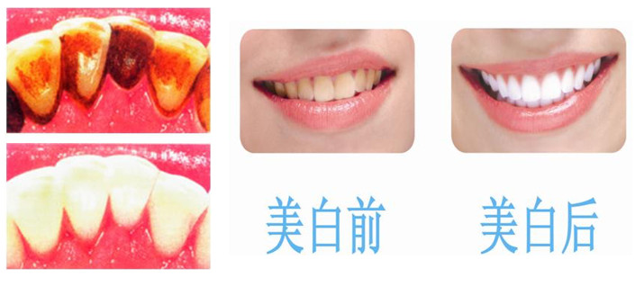 牙齿美白.jpg